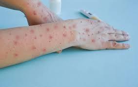 First Mpox Case in Eastern Visayas, Confirmed; LGU Task Force to Lead Control in Virus Spread, Organized.