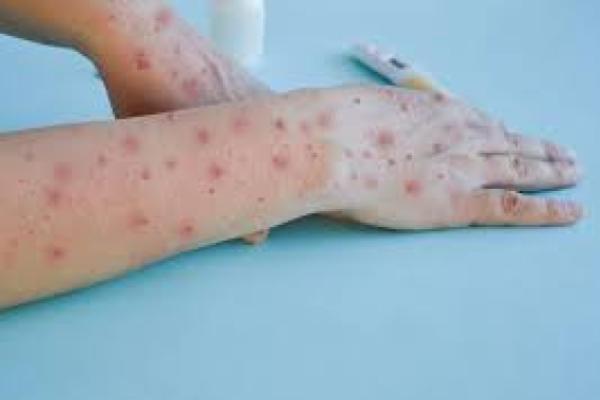 First Mpox Case in Eastern Visayas, Confirmed; LGU Task Force to Lead Control in Virus Spread, Organized.
